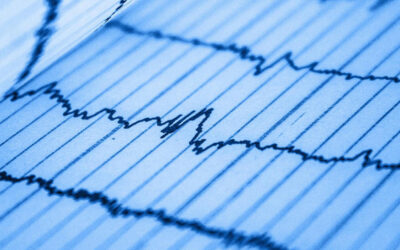 Los pacientes con cáncer tienen un 20% mas de probabilidad de desarrollar fibrilación auricular que el resto de población