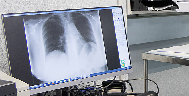 En el primer trimestre de 2022 se realizará un programa piloto de cribado de cáncer de pulmón dirigido a fumadores y exfumadores de entre 50 y 75 años